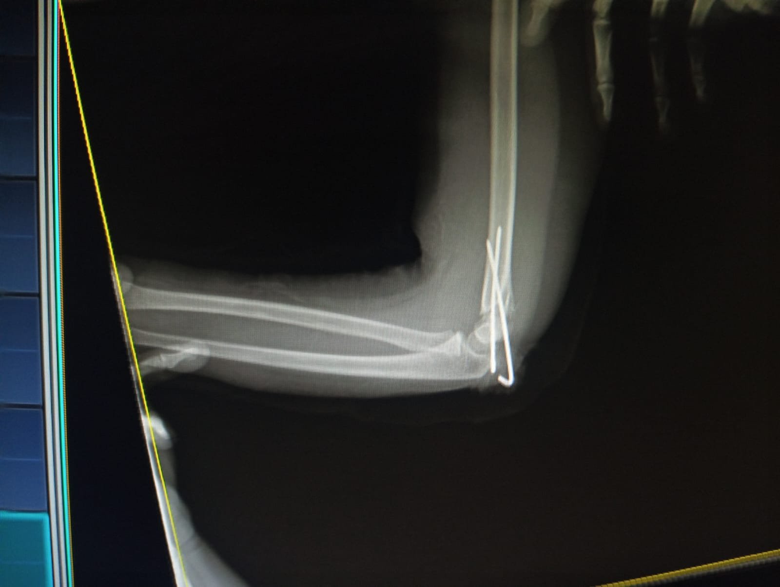 Pediatric Supracondylar Fracture